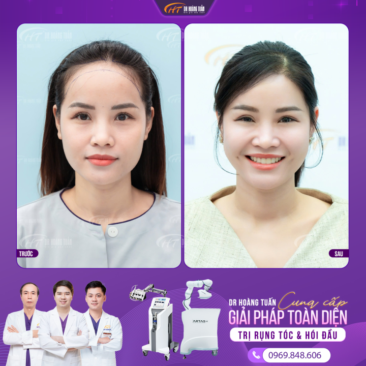 Phụ nữ có bị hói đầu không? Nguyên nhân, dấu hiệu và cách khắc phục